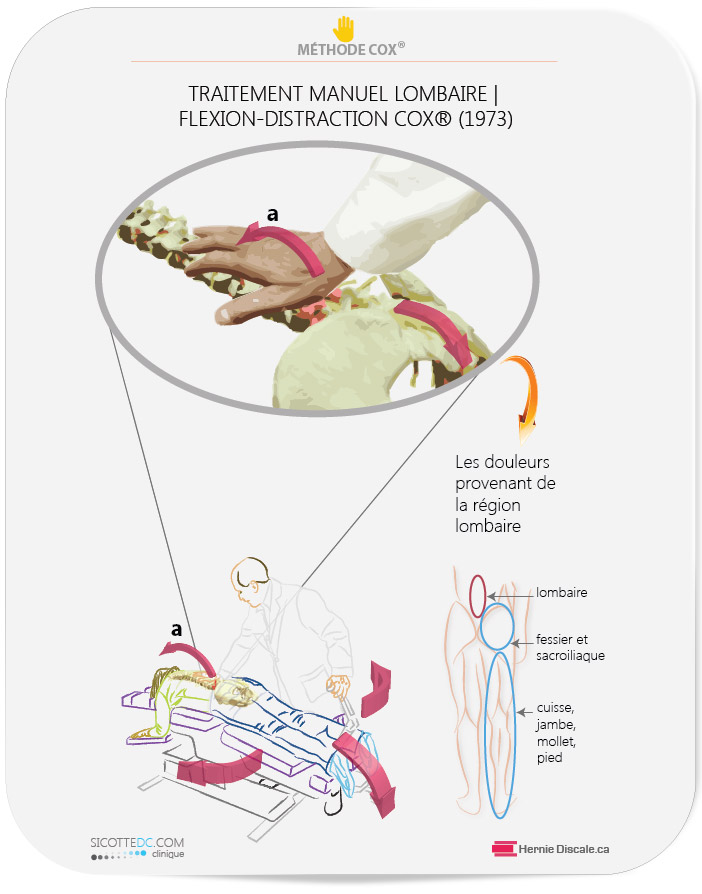 Les traitements Cox en flexion distraction pour l'arthrose lombaire.