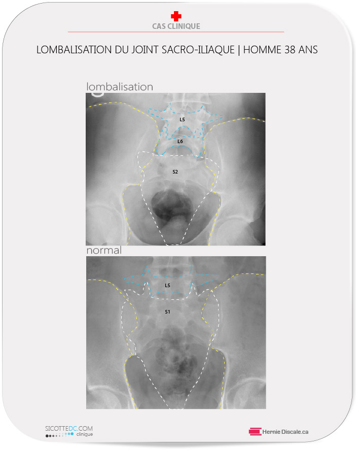 Anomalie du joint sacro-iliaque, lombarisation S1.