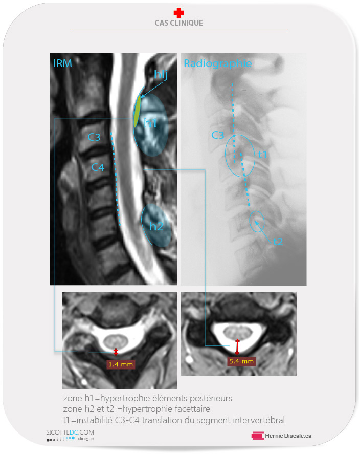 Les symptômes d'une patiente avec instabilitée cervicale C3-C4 cause une sténose spinale.