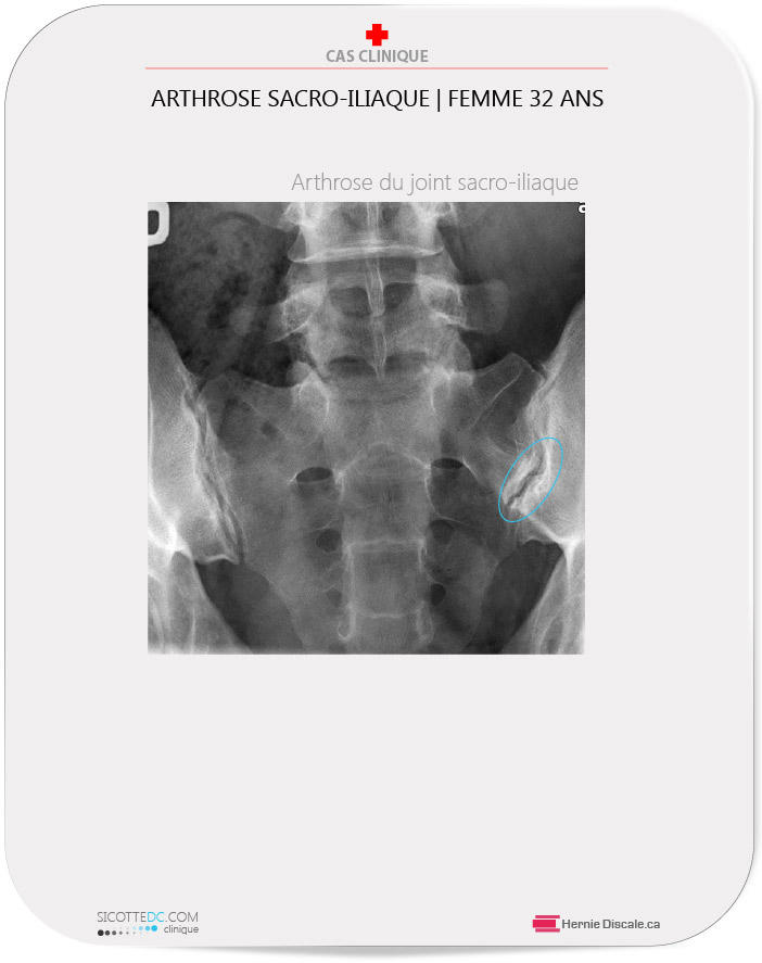 L'arthrose du joint sacro-iliaque radiographie.