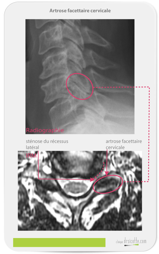 L'artrose facettaire cervicale et la sténose du récessus latéral radiographie et IRM.