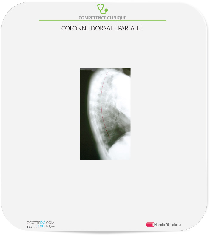 Radiographie cyphose dorsale, courbe milieu du dos.