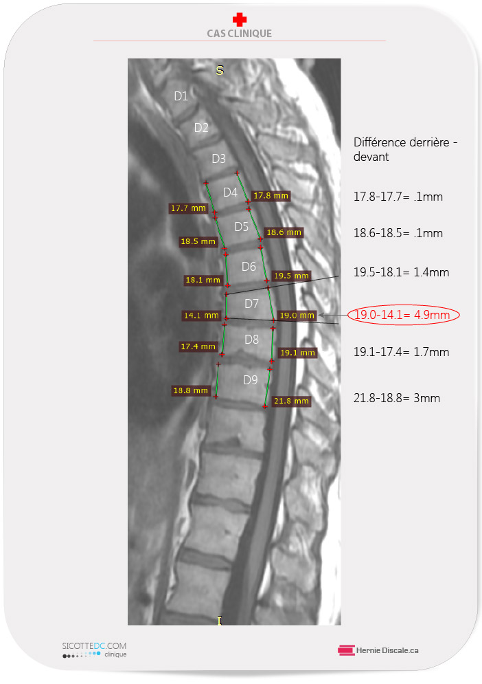 IRM analyse douleurs entre les omoplates, déformitée du corp vertébrale