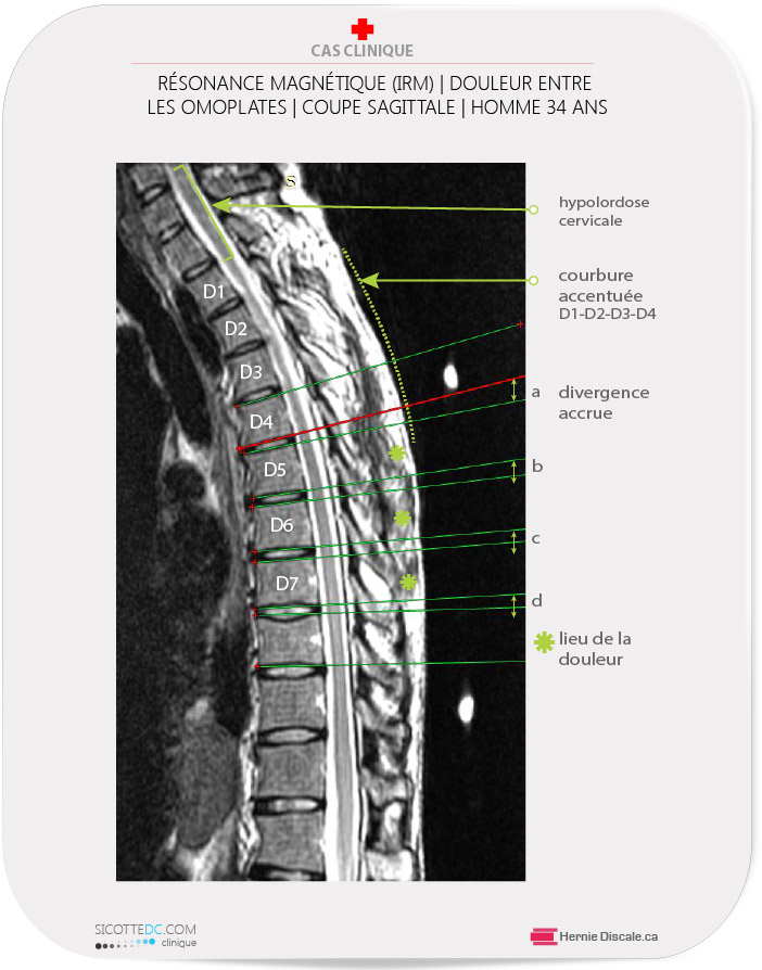 Douleur entre les omoplate - D5, D6, D7.  IRM