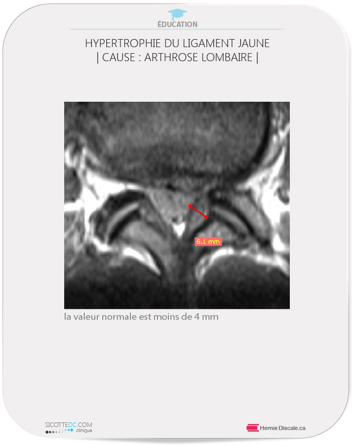 L'hypertrophie du ligament jaune de la colonne vertébrale lombaire.