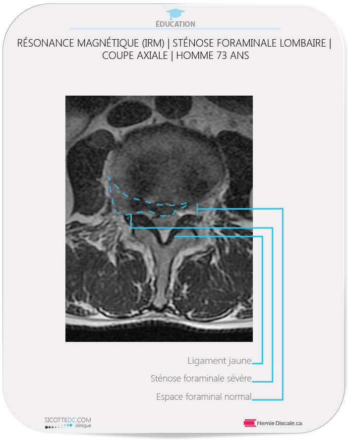 Imagerie par résonance magnetique homme 73 ans - Hernie discale L4-L5.Résonance magnétique (IRM)  | example de sténose foraminale lombaire coupe axial