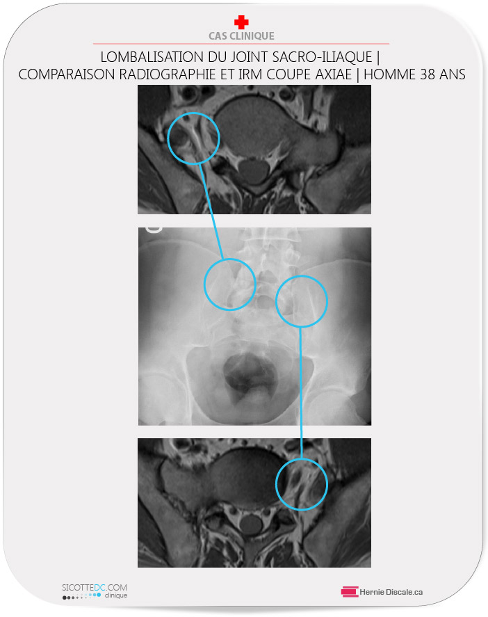 La lombalisation du joint sacro-iliaque comparaison de la radiographie et IRM coupe-axial. Cas clinique et traitement.