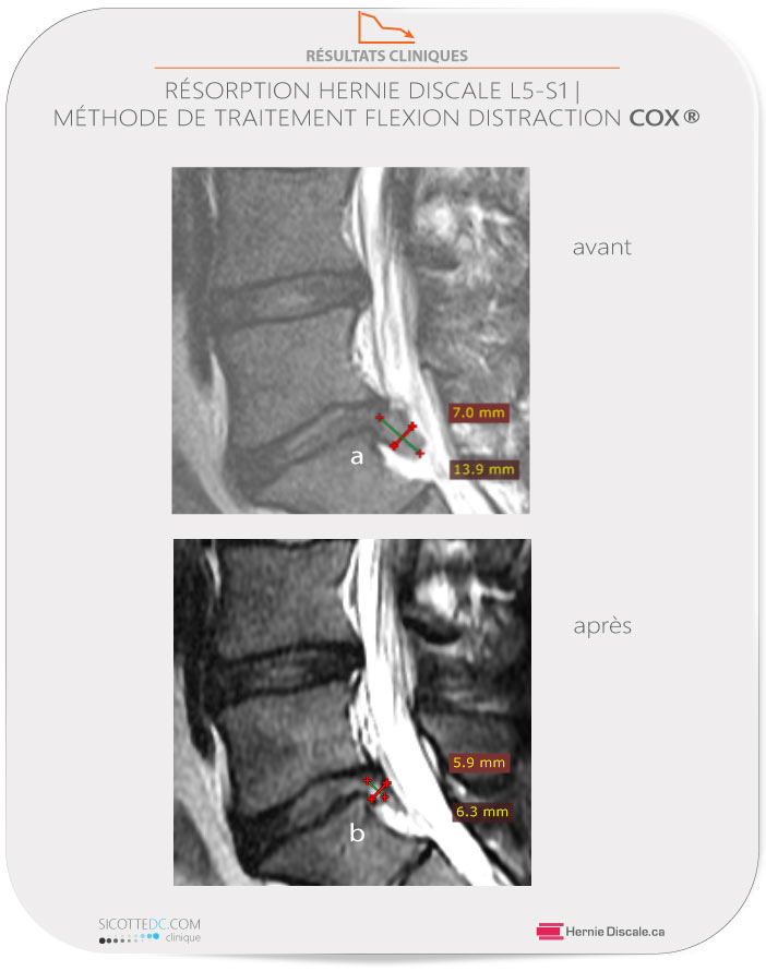 La résorption d’une hernie discale sous soins de la méthode Cox : IRM avant après. Images sagittales démontrant la résorption d'une hernie discale lombaire à L5-S1.