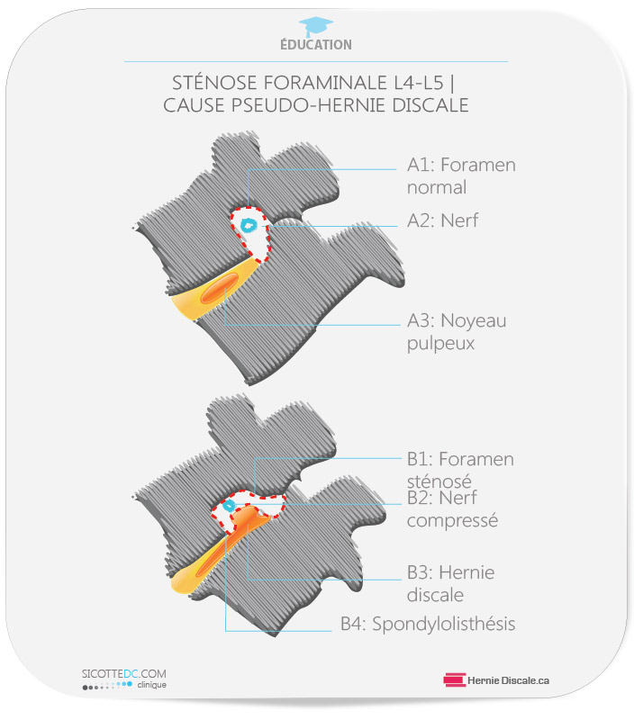 Sténose foraminale cause: spondylolisthésis L5-S1