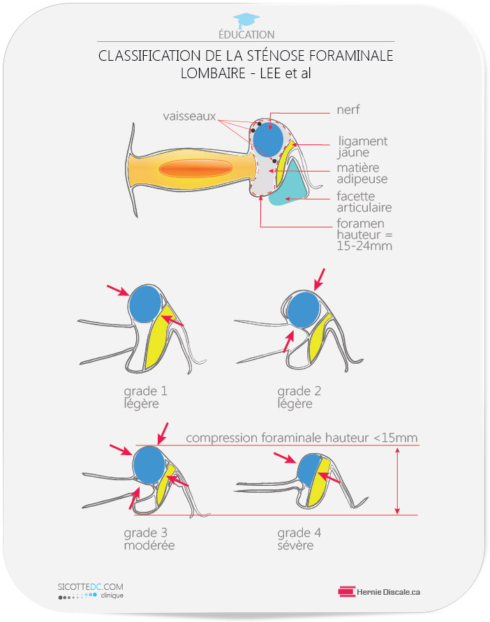 La classification de la sténose foraminale lombaire.