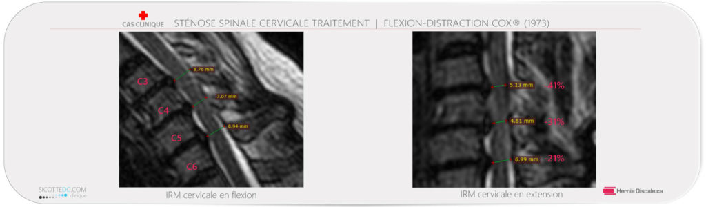 Flexion extension IRM cervicale stenose spinale cervicale.