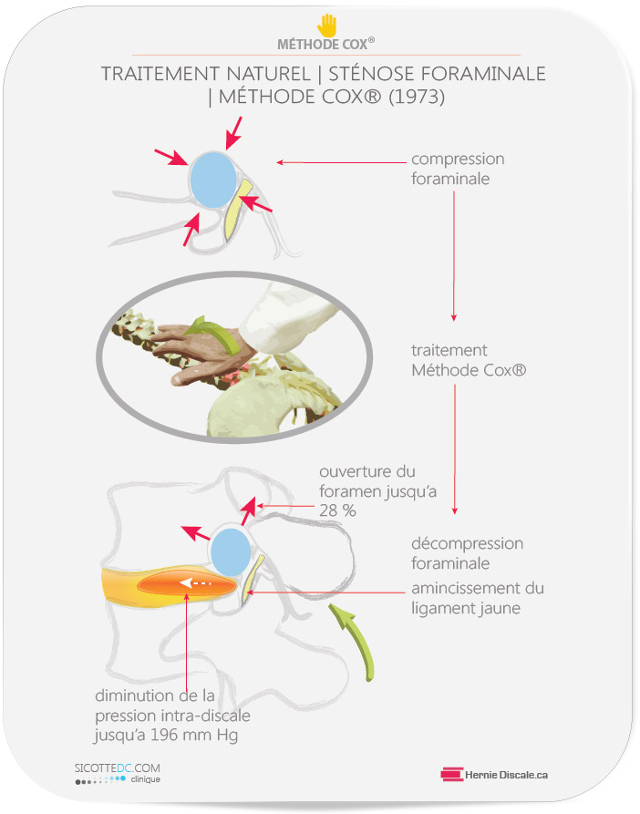 Le traitement naturel pour la sténose foraminale lombaire causée par de l'arthrose facettaire; méthode Cox®.