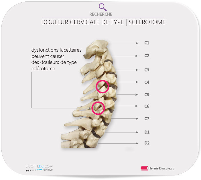 La colone vertébrale cervicale. Dysfonction facettaires peuvent causer des douleurs de type sclérotome.